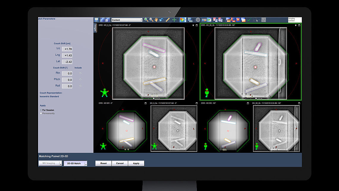 LINAC QA Alignment errors detected using MV images (EPID) generated by VARIAN TrueBeam system