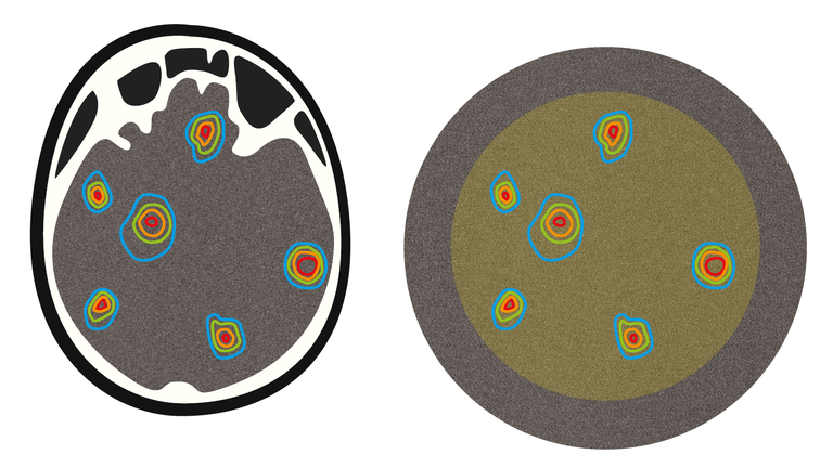 OCTAVIUS Detector 1600 MR: Verification of stereotactic target volumes - Multiple brain metastases