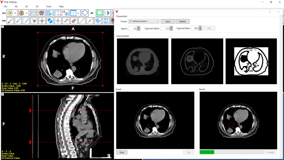 VERIQA visualization tools for plan review: auto contouring based on grey value and edge detection