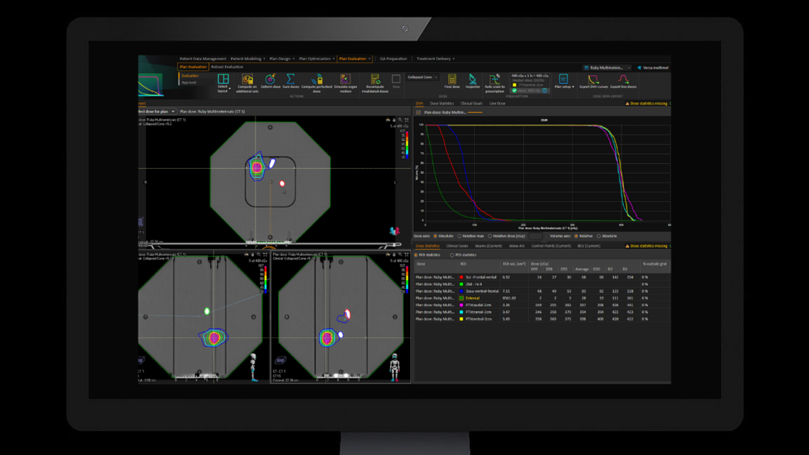 Multiple metastasis applications: Single isocenter treatment plan irradiating three target volumes. Target volumes are contoured at the detector positions. Isocenter is placed at the center of the phantom.